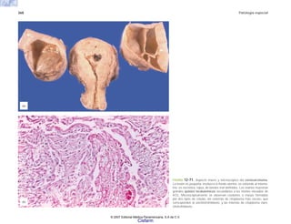368 Patología especial
FIGURA 12-71. Aspecto macro y microscópico del coriocarcinoma.
La lesión es pequeña, involucra el fondo uterino, se extiende al miome-
trio; es necrótica, rojiza, de bordes mal definidos. Los ovarios muestran
grandes quistes tecaluteínicos secundarios a los niveles elevados de
hCG. Microscópicamente se observan cordones o masas formadas
por dos tipos de células, las externas de citoplasma más oscuro, que
corresponden al sincitiotrofoblasto, y las internas de citoplasma claro,
citotrofoblasto.
(b)
(a)
© 2007 Editorial Médica Panamericana, S.A de C.V.
Cisfarm
 