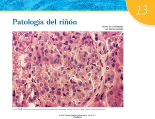 13
Patología del riñón
Patología del riñón Beatríz De León Bojorge
Luis Salinas Madrigal
FIGURA 13-1. Glomerulonefritis posinfecciosa con proliferación mesangial, oclusión de la luz capilar y algunos polimorfonucleares.
© 2007 Editorial Médica Panamericana, S.A de C.V.
Cisfarm
 