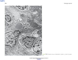 378 Patología especial
FIGURA 13-2. Depósitos densos subepiteliales (“jorobas”) y fusión de podoci-
tos.
© 2007 Editorial Médica Panamericana, S.A de C.V.
Cisfarm
 