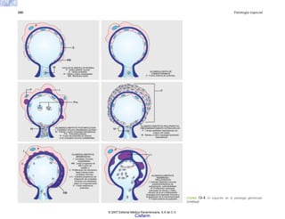 380 Patología especial
FIGURA 13-4. El espectro de la patología glomerular.
(Continúa)
© 2007 Editorial Médica Panamericana, S.A de C.V.
Cisfarm
 