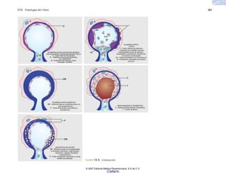 C13 Patología del riñón 381
FIGURA 13-4. (Continuación).
© 2007 Editorial Médica Panamericana, S.A de C.V.
Cisfarm
 