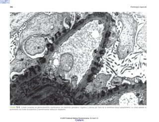 382 Patología especial
FIGURA 13-5. Estadio temprano de glomerulonefritis membranosa con depósitos granulares, regulares y densos por fuera de la membrana basal (subepiteliales). La célula epitelial es
prominente con fusión de podocitos y transformación vellosa de citoplasma.
© 2007 Editorial Médica Panamericana, S.A de C.V.
Cisfarm
 