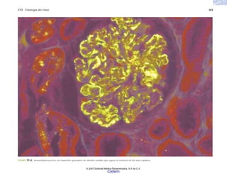 C13 Patología del riñón 383
FIGURA 13-6. lnmunofluorescencia con depósitos granulares de tamaño variable que siguen el contorno de las asas capilares.
© 2007 Editorial Médica Panamericana, S.A de C.V.
Cisfarm
 