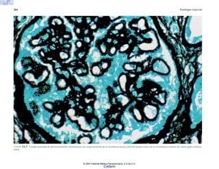 384 Patología especial
FIGURA 13-7. Estadio avanzado de glomerulonefritis membranosa con engrosamiento de la membrana basal y además proyecciones de la membrana a manera de clavas (plata metena-
mina).
© 2007 Editorial Médica Panamericana, S.A de C.V.
Cisfarm
 