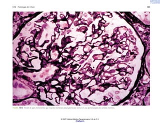 C13 Patología del riñón 385
FIGURA 13-8. Tinción de plata metenamina que muestra membrana basal glomerular normal en una glomerulopatía de cambios mínimos.
© 2007 Editorial Médica Panamericana, S.A de C.V.
Cisfarm
 