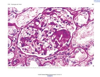 C13 Patología del riñón 387
FIGURA 13-10. Esclerosis focal y segmentaria cerca del polo vascular y adherencias a la cápsula de Bowman (PAS).
© 2007 Editorial Médica Panamericana, S.A de C.V.
Cisfarm
 