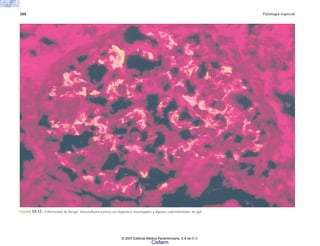 388 Patología especial
FIGURA 13-11. Enfermedad de Berger. lnmunofluorescencia con depósitos mesangiales y algunos subendoteliales de IgA.
© 2007 Editorial Médica Panamericana, S.A de C.V.
Cisfarm
 
