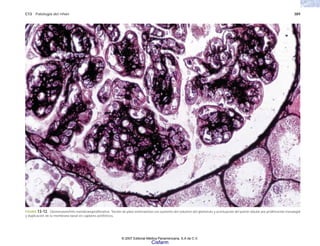 C13 Patología del riñón 389
FIGURA 13-12. Glomerulonefritis membranoproliferativa. Tinción de plata metenamina con aumento del volumen del glomérulo y acentuación del patrón lobular por proliferación mesangial
y duplicación de la membrana basal en capilares periféricos.
© 2007 Editorial Médica Panamericana, S.A de C.V.
Cisfarm
 