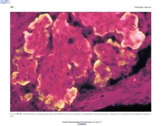 390 Patología especial
FIGURA 13-13. Glomerulonefritis membranoproliferativa. lnmunofluorescencia con depósitos subendoteliales abundantes gruesos, dispuestos en la periferia de las lobulaciones glomeru-
lares.
© 2007 Editorial Médica Panamericana, S.A de C.V.
Cisfarm
 