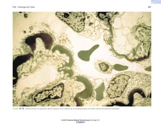 C13 Patología del riñón 391
FIGURA 13-14. Ultraestructura con depósitos densos gruesos en el espesor de la membrana basal con fusión extensa de podocitos epiteliales.
© 2007 Editorial Médica Panamericana, S.A de C.V.
Cisfarm
 