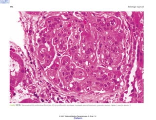 392 Patología especial
FIGURA 13-15. Glomerulonefritis proliferativa difusa (tipo IV) con proliferación acentuada mesangial, polimorfonucleares y paredes gruesas, rígidas (“asas de alambre”).
© 2007 Editorial Médica Panamericana, S.A de C.V.
Cisfarm
 