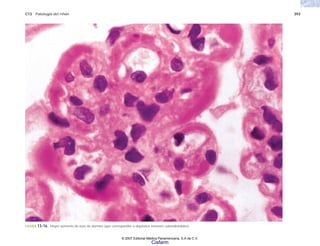 C13 Patología del riñón 393
FIGURA 13-16. Mayor aumento de asas de alambre (que corresponden a depósitos inmunes subendoteliales).
© 2007 Editorial Médica Panamericana, S.A de C.V.
Cisfarm
 