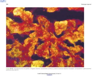 394 Patología especial
FIGURA 13-17. Inmunofluorescencia con grandes e irregulares depósitos subendoteliales periféricos y además numerosos depósitos mesangiales, correspondiente a glomerulonefritis
proliferativa difusa (tipo IV).
© 2007 Editorial Médica Panamericana, S.A de C.V.
Cisfarm
 