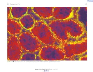 C13 Patología del riñón 395
FIGURA 13-18. Inmunofluorescencia con depósitos inmunes en la membrana basal de túbulos en nefritis intersticial lúpica.
© 2007 Editorial Médica Panamericana, S.A de C.V.
Cisfarm
 