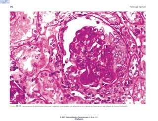 396 Patología especial
FIGURA 13-19. Glomerulonefritis proliferativa intra (color magenta) y extracapilar con adherencias a la cápsula de Bowman en una púrpura de Henoch-Schönlein.
© 2007 Editorial Médica Panamericana, S.A de C.V.
Cisfarm
 