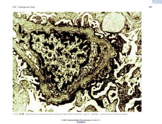 C13 Patología del riñón 397
FIGURA 13-20. Ultraestructura con membrana basal anormal por fragmentación, laminación y aspecto “apolillado”, característico del síndrome de Alport.
© 2007 Editorial Médica Panamericana, S.A de C.V.
Cisfarm
 
