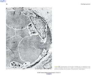 38 Patología general
FIGURA 3-2. Demostración de dos poros formados por la separación de las
células endoteliales (flechas) de un capilar. La luz está llena de eritrocitos y dos
de ellos se insinúan entre los poros. (Cortesía del Dr. Guido Majno.)
© 2007 Editorial Médica Panamericana, S.A de C.V.
Cisfarm
 