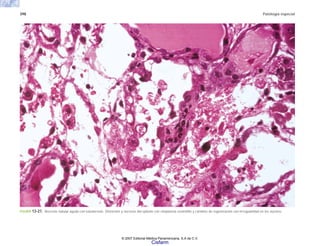 398 Patología especial
FIGURA 13-21. Necrosis tubular aguda con tubulorrexis. Distorsión y necrosis del epitelio con citoplasma eosinófilo y cambios de regeneración con irrregularidad en los núcleos.
© 2007 Editorial Médica Panamericana, S.A de C.V.
Cisfarm
 
