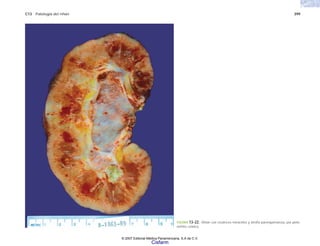 C13 Patología del riñón 399
FIGURA 13-22. Riñón con cicatrices retráctiles y atrofia parenquimatosa, por pielo-
nefritis crónica.
© 2007 Editorial Médica Panamericana, S.A de C.V.
Cisfarm
 