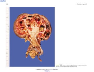 400 Patología especial
FIGURA 13-23. Riñón al corte con gran dilatación de cálices y pelvicilla,
cálculos en cálices y atrofia del parénquima renal.
© 2007 Editorial Médica Panamericana, S.A de C.V.
Cisfarm
 