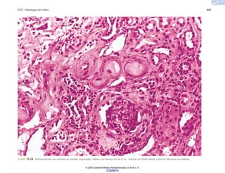C13 Patología del riñón 401
FIGURA 13-24. Nefroesclerosis con arteriolas de paredes engrosadas, hialinas con obstrucción de la luz. Además de atrofia tubular y fibrosis intersticial secundarias.
© 2007 Editorial Médica Panamericana, S.A de C.V.
Cisfarm
 