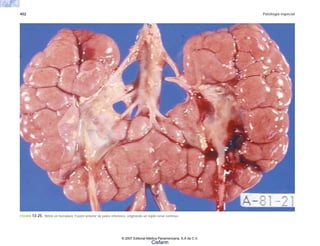 402 Patología especial
FIGURA 13-25. Riñón en herradura. Fusión anterior de polos inferiores, originando un tejido renal continuo.
© 2007 Editorial Médica Panamericana, S.A de C.V.
Cisfarm
 