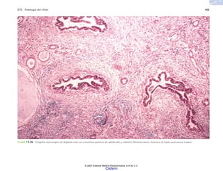 C13 Patología del riñón 403
FIGURA 13-26. Fotografía microscópica de displasia renal con estructuras quísticas de epitelio alto y collaretes fibromusculares. Ausencia de tejido renal normal maduro.
© 2007 Editorial Médica Panamericana, S.A de C.V.
Cisfarm
 