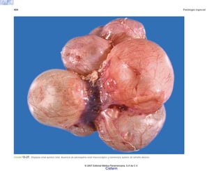 404 Patología especial
FIGURA 13-27. Displasia renal quística total. Ausencia de parénquima renal macroscópico y numerosos quistes de tamaño diverso.
© 2007 Editorial Médica Panamericana, S.A de C.V.
Cisfarm
 