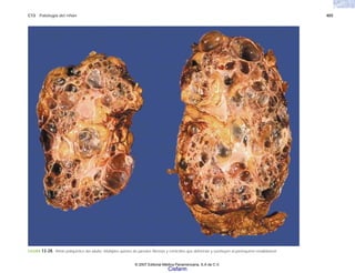 C13 Patología del riñón 405
FIGURA 13-28. Riñón poliquístico del adulto. Múltiples quistes de paredes fibrosas y retráctiles que deforman y sustituyen al parénquima renalbilateral
© 2007 Editorial Médica Panamericana, S.A de C.V.
Cisfarm
 