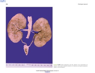 406 Patología especial
FIGURA 13-29. Riñón poliquístico del niño. Riñones muy aumentados de
tamaño, conservado el aspecto reniforme, sin fibrosis y con quistes pequeños
radiales corticomedulares.
© 2007 Editorial Médica Panamericana, S.A de C.V.
Cisfarm
 