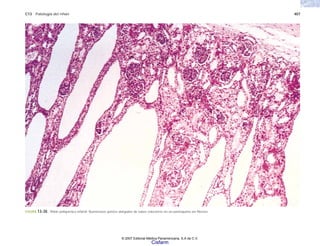 C13 Patología del riñón 407
FIGURA 13-30. Riñón poliquístico infantil. Numerosos quistes alargados de tubos colectores en un parénquima sin fibrosis.
© 2007 Editorial Médica Panamericana, S.A de C.V.
Cisfarm
 