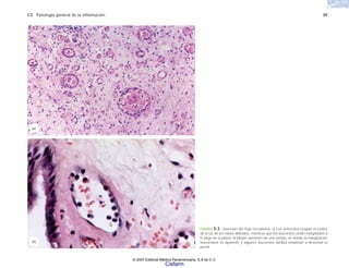 C3 Patología general de la inflamación 39
FIGURA 3-3. Inversión del flujo circulatorio. a) Los eritrocitos ocupan el centro
de la luz de los vasos dilatados, mientras que los leucocitos están marginados a
lo largo de la pared. b) Mayor aumento de una vénula, en donde la marginación
leucocitaria es aparente y algunos leucocitos (arriba) empiezan a atravesar la
pared.
(a)
(b)
© 2007 Editorial Médica Panamericana, S.A de C.V.
Cisfarm
 