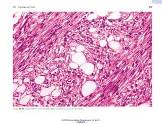C13 Patología del riñón 409
FIGURA 13-32. Angiomiolipoma renal con tejido adiposo maduro y fascículos de músculo liso.
© 2007 Editorial Médica Panamericana, S.A de C.V.
Cisfarm
 