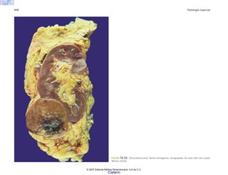 410 Patología especial
FIGURA 13-33. Oncocitoma renal. Tumor homogéneo, encapsulado, de color café con cicatriz
fibrosa central.
© 2007 Editorial Médica Panamericana, S.A de C.V.
Cisfarm
 