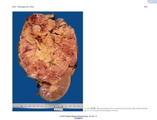 C13 Patología del riñón 411
FIGURA 13-34. Adenocarcinoma renal. Se observa una masa de tejido amarillo naranja
de 15 cm con áreas de hemorragia y necrosis.
© 2007 Editorial Médica Panamericana, S.A de C.V.
Cisfarm
 