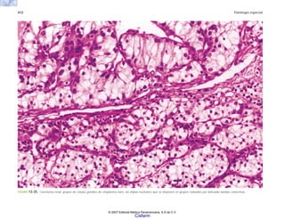 412 Patología especial
FIGURA 13-35. Carcinoma renal: grupos de células grandes de citoplasma claro, sin atipias nucleares que se disponen en grupos rodeados por delicadas bandas conectivas.
© 2007 Editorial Médica Panamericana, S.A de C.V.
Cisfarm
 
