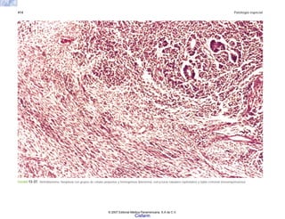 414 Patología especial
FIGURA 13-37. Nefroblastoma. Neoplasia con grupos de células pequeñas y homogéneas (blastema), estructuras tubulares (epiteliales) y tejido estromal (mesenquimatoso).
© 2007 Editorial Médica Panamericana, S.A de C.V.
Cisfarm
 