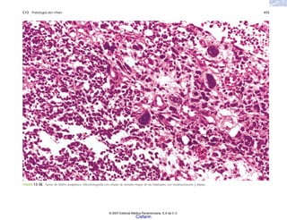 C13 Patología del riñón 415
FIGURA 13-38. Tumor de Wilms anaplásico. Microfotografía con células de tamaño mayor de las habituales con multinucleación y atipias.
© 2007 Editorial Médica Panamericana, S.A de C.V.
Cisfarm
 