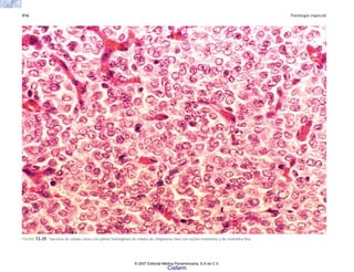 416 Patología especial
FIGURA 13-39. Sarcoma de células claras con patrón homogéneo de células de citoplasma claro con núcleo monótono y de cromatina fina.
© 2007 Editorial Médica Panamericana, S.A de C.V.
Cisfarm
 