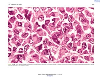 C13 Patología del riñón 417
FIGURA 13-40. Tumor rabdoide maligno. Neoplasia con células grandes con núcleo de cromatina granular y nucleolo prominente eosinófilo con citoplasma abundante y la presencia de una
zona clara “inclusión”, que rechaza al núcleo.
© 2007 Editorial Médica Panamericana, S.A de C.V.
Cisfarm
 