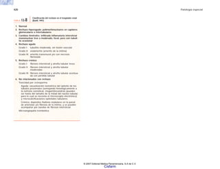 420 Patología especial
1. Normal
2. Rechazo híperagudo: polimorfonucleares en capilares
glomerulares o intertubulares
3. Cambios limítrofes: infiltrado inflamatorio intersticial
mononuclear leve a moderado, focal, pero con tubuli-
tis ocasional
4. Rechazo agudo
Grado I: tubulitis moderada, sin lesión vascular
Grado II: endarteritis (arteritis de la íntima)
Grado III: arteritis transmural y/o con necrosis
fibrinoide
5. Rechazo crónico
Grado I: fibrosis intersticial y atrofia tubular leves
Grado II: fibrosis intersticial y atrofia tubular
moderadas
Grado III: fibrosis intersticial y atrofia tubular acentua-
da con pérdida tubular
6. No relacionados con rechazo
Toxicidad por ciclosporina
Aguda: vacuolización ísométrica del epitelio de los
túbulos proximales (semejando histológicamente a
la nefrosis osmótica), megamitocondrias (pueden
ser hasta del tamaño de la mitad del núcleo tubular,
para lo cual se necesita el microscopio electrónico)
y microcalcificaciones epiteliales tubulares
Crónica: depósitos hialinos nodulares en la pared
de arteriolas y/o fibrosis de la íntima, y se pueden
acompañar por bandas de fibrosis intersticial.
Microangiopatía trombótica
TABLA 13-8
Clasificación del rechazo en el trasplante renal
(Banff, 1997)
© 2007 Editorial Médica Panamericana, S.A de C.V.
Cisfarm
 