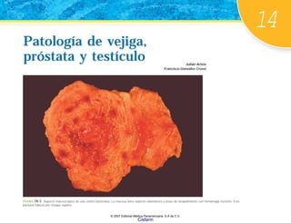 14
Patología de vejiga,
próstata y testículo
Patología de vejiga,
próstata y testículo Julián Arista
Francisco González Crussi
FIGURA 14-1. Aspecto macroscópico de una cistitis bacteriana. La mucosa tiene aspecto edematoso y áreas de despulimiento con hemorragia reciente. Este
paciente falleció por choque séptico.
© 2007 Editorial Médica Panamericana, S.A de C.V.
Cisfarm
 