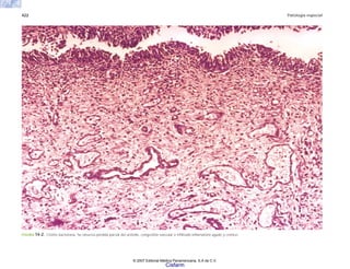422 Patología especial
FIGURA 14-2. Cistitis bacteriana. Se observa pérdida parcial del urotello, congestión vascular o infiltrado inflamatorio agudo y crónico.
© 2007 Editorial Médica Panamericana, S.A de C.V.
Cisfarm
 