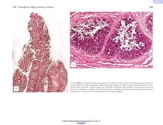 C14 Patología de vejiga, próstata y testículo 425
FIGURA 14-5. a) Carcinoma transicional grado II. Se observa un tallo central de tipo fibrovascular en torno al
cual se disponen células neoplásicas multiestratificadas. Algunas de ellas muestran atipia moderada. Los car-
cinomas que conservan el patrón papliar son clasificados como bien diferenciados. b) Carcinoma transicional
grado III. La neoplasia se dispone en nidos de límites bien definidos que infiltran el músculo de la pared vesical.
El pronóstico es peor que las neoplasias que muestran patrón papilar.
(a)
(b)
© 2007 Editorial Médica Panamericana, S.A de C.V.
Cisfarm
 