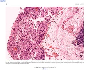 426 Patología especial
FIGURA 14-6. Carcinoma transicional in situ. Se observa engrosamiento de la mucosa por la multiestratificación de las células malignas. El número de capas (más de diez) que existe en
este tipo de tumores es uno de los criterios más importantes para clasificarlo como maligno. La neoplasia no rebasa la membrana basal y no hay infiltración a la lámina propia. Cuando se
diagnostica en este estadio el pronóstico es muy bueno.
© 2007 Editorial Médica Panamericana, S.A de C.V.
Cisfarm
 
