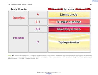 C14 Patología de vejiga, próstata y testículo 427
FIGURA 14-7. Pronóstico del carcinoma vesical. Las neoplasias no infiltrantes tienen un buen pronóstico. La infiltración a capas musculares y al tejido perivesical es un dato desfavorable,
ya que la presencia de vasos en estos sitios favorece la diseminación. La sobrevida a cinco años en estos casos es casi de 50%. Las metástasis a los ganglios linfáticos regionales implican
un pésimo pronóstico y la mortalidad a largo plazo es casi de 100%.
© 2007 Editorial Médica Panamericana, S.A de C.V.
Cisfarm
 