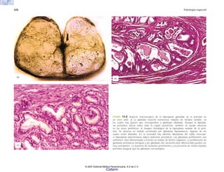 428 Patología especial
FIGURA 14-8. Aspecto macroscópico de la hiperplasla glandular de la próstata en
un corte axial. a) La glándula muestra numerosos nódulos de tamaño variable, en
los cuales hay quistes que corresponden a glándulas dilatadas. Aunque la hiperpla-
sia prostática afecta sobre todo la región periuretral, también se puede observar
en las áreas periféricas. b) Imagen histológica de la hiperplasla nodular de la prós-
tata. Se observa un nódulo constituido por glándulas hiperplásicas, algunas de las
cuales están dilatadas. En la vecindad hay además hiperplasia del tejido muscular.
c) Hiperplasia adenomatosa atípica (adenosis prostática). Las glándulas proliferantes son
uniformes, bien diferenciadas y forman un nódulo de límites regulares. La proliferación de
glándulas prostáticas benignas y las glándulas del carcinoma bien diferenciado pueden ser
muy semejantes. La ausencia de nucleolos prominentes y la presencia de células basales
permiten asegurar que las glándulas son benignas.
(c)
(b)
(a)
© 2007 Editorial Médica Panamericana, S.A de C.V.
Cisfarm
 
