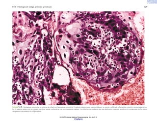 C14 Patología de vejiga, próstata y testículo 429
FIGURA 14-9. Metaplasia escamosa en un área de infarto en hiperplasia prostática. El epitelio epidermoide muestra atipia y se asocia a infiltrado inflamatorio crónico y hemorragia recien-
te. El aspecto atípico de las células reactivas puede confundirse con una neoplasia maligna. Los infartos se producen por una deficiente irrigación, quizá por la compresión de los vasos
sanguíneos secundarios a la hiperplasia.
© 2007 Editorial Médica Panamericana, S.A de C.V.
Cisfarm
 