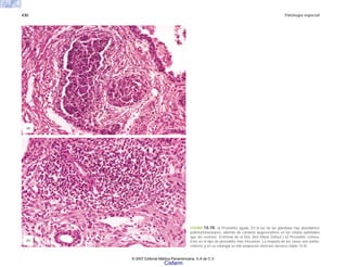 430 Patología especial
FIGURA 14-10. a) Prostatitis aguda. En la luz de las glándulas hay abundantes
polimorfonucleares, además de cambios degenerativos en las células epiteliales
que las revisten. (Cortesía de la Dra. Ana María Gómez.) b) Prostatitis crónica.
Éste es el tipo de prostatitis más frecuente. La mayoría de los casos son asinto-
máticos y en su etiología se han propuesto diversos factores (tabla 14-4).
(b)
(a)
© 2007 Editorial Médica Panamericana, S.A de C.V.
Cisfarm
 