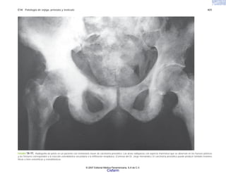 C14 Patología de vejiga, próstata y testículo 431
FIGURA 14-11. Radiografía de pelvis en un paciente con metástasis óseas de carcinoma prostático. Las áreas radiopacas con aspecto marmóreo que se observan en los huesos pélvicos
y los fémures corresponden a la reacción osteoblástica secundaria a la infiltración neoplásica. (Cortesía del Dr. Jorge Hernández.) El carcinoma prostático puede producir también lesiones
líticas o bien osteolíticas y osteoblásticas.
© 2007 Editorial Médica Panamericana, S.A de C.V.
Cisfarm
 